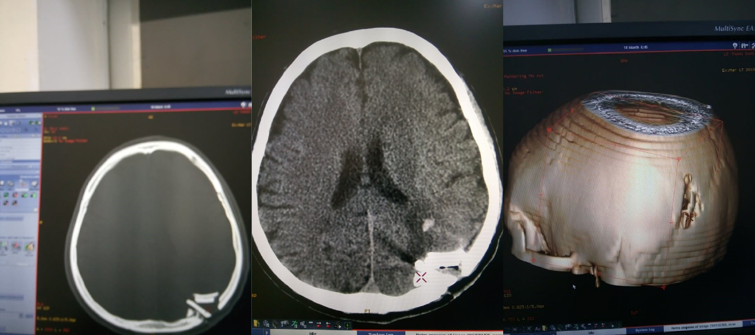 BN: Lâm Thanh S.	69 tuổi	TXQT	Khoa: KB Ngày chụp: 	15/03/2019	 Kết quả: Hình ảnh Vở lún xương hộp sọ có mảnh rời, kèm viêm dập não, xuất huyết dưới nhện tại vùng đỉnh-chẩm trái (có tái cấu trúc dựng hình 3D)